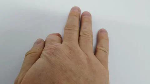 Amputated finger. Fotos Stock