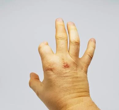 Amputated finger. Fotos Stock