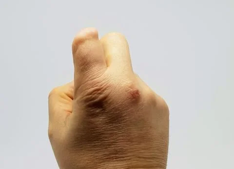 Amputated finger. Fotos Stock