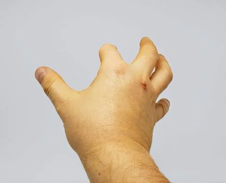 Amputated finger. Fotos Stock