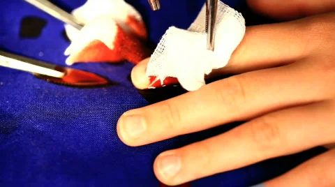Amputation of a finger 스톡 동영상 779405