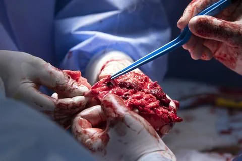 Amputation surgery close-up with electrosurgical forceps usage 写真素材