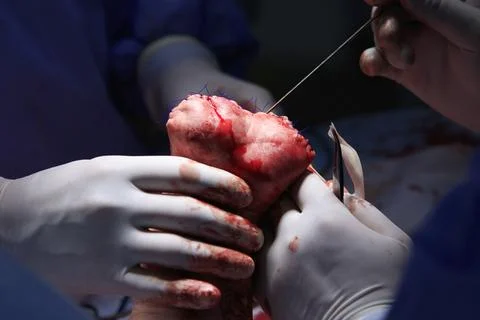 Amputation Surgery Macro 写真素材