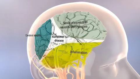 Amyloid Precursor Protein Processing and Alzheimer s Disease Stock Illustration