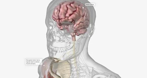 Amyotropic lateral sclerosis (ALS) is a progressive neurodegenerative disorde Stock Illustration