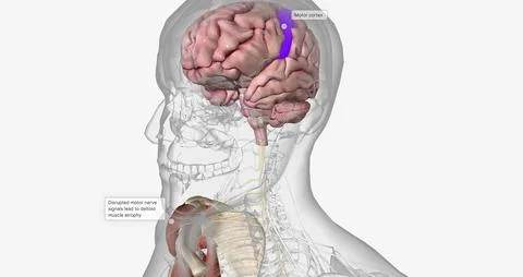 Amyotropic lateral sclerosis (ALS) is a progressive neurodegenerative disorde Stock Illustration