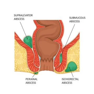 Anal abscess. Vector illustration Stock Illustration