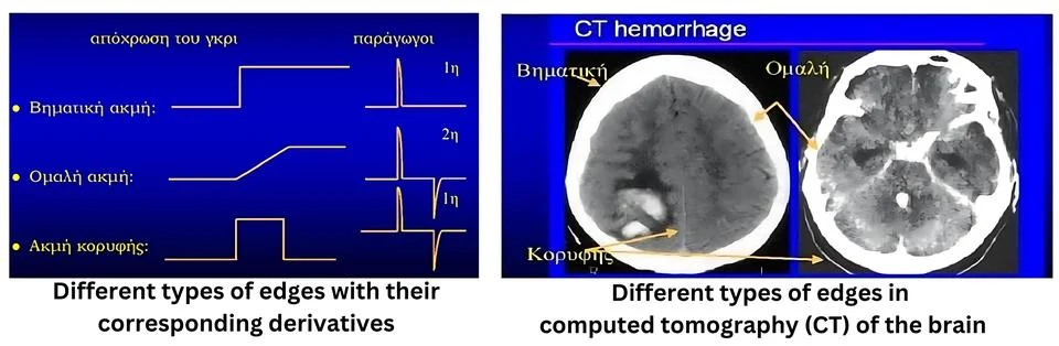 Analysis of Edge Types and Their Derivatives in CT Brain Imaging for Hemorr.. Stock Photos