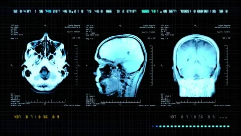 Analyzing Brain Scan MRI with tumor or cancer medical reseach Health Care Stock Footage 336561094