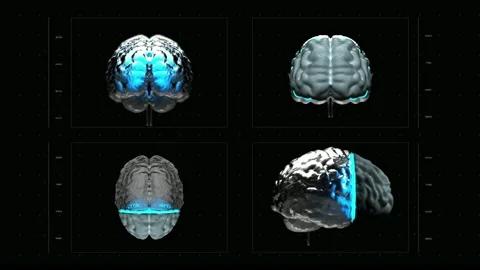 Analyzing Brain Scan MRI with tumor or cancer medical reseach Health Care Stock Footage 336561174