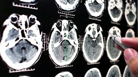 Analyzing Brain Scan MRI with tumor or cancer medical reseach Health Care Stock Footage 336561194