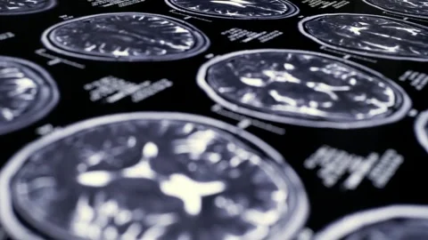 Analyzing Brain Scan MRI with tumor or cancer medical reseach Health Care Stock Footage 336561219