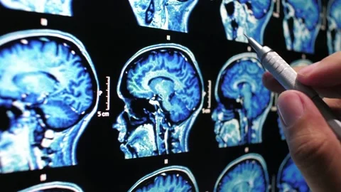 Analyzing Brain Scan MRI with tumor or cancer medical reseach Health Care Video stock 336569303