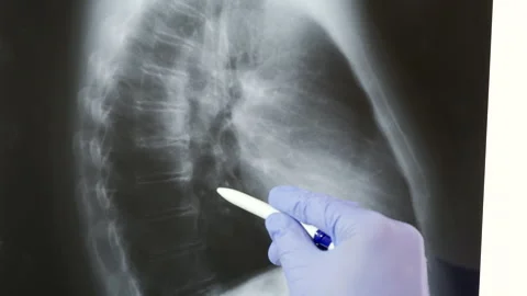 Analyzing the chest with x-ray Stock-Footage 283541978