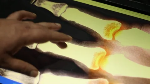 Analyzing of Hand Bones on Touch Screen Display. Doctor and MRI Scan. 스톡 동영상 100632611