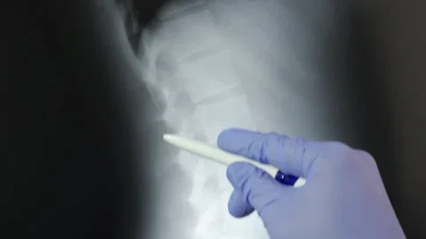 Analyzing the spinal column Vidéo 292381369
