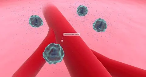 Anaphylaxis, Histamine Release and Vascular Edema Stock Illustration