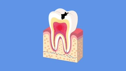 Anatomical Cross Section of Human Tooth with Cavity and Inflammation Stock Footage 328833195