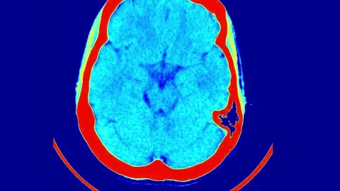 Anatomical MRI Analysis of the Human Brain: Visualizing Cerebral Structures with Stock Footage 317739224