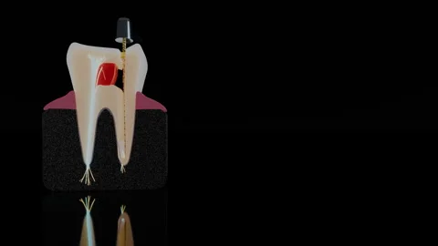 Anatomical tooth cross section with dental file and nerve branches, 4K Stock Footage 346121063