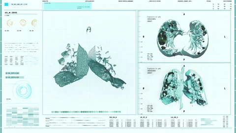 Anatomy Analysis Medical Interface Scanning Human Lungs Respiratory System Stock Footage 169977187