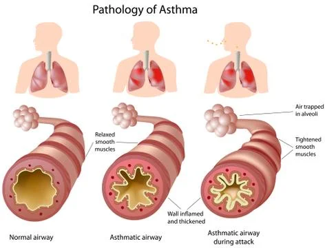 Anatomy of Asthma Stock Illustration