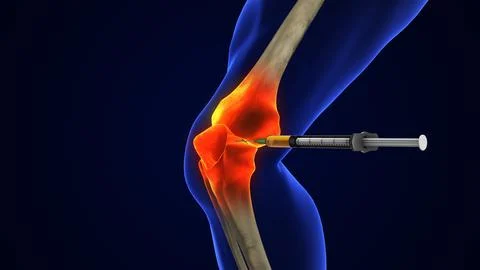 Anatomy Human Knee Joint Treatment, Osteoarthritis Injection イラスト素材