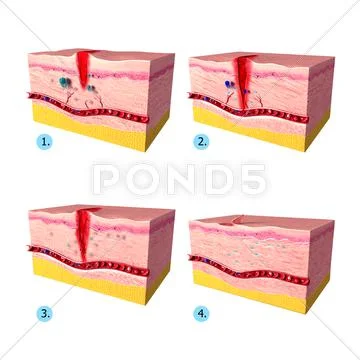 Anatomy of tissue repair in human skin: Graphic #39549873