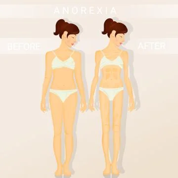 Before and after anorexia Illustrazione stock