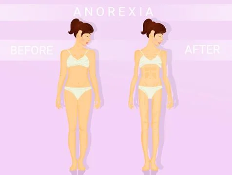 Before and after anorexia Illustrazione stock
