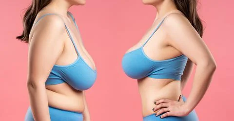 Before and after breast augmentation concept, woman with very large silicone  Stock Photos