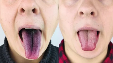 Before and after. Close-up of a man black tongue. Clinical manifestations of lin Stock Footage 166098392