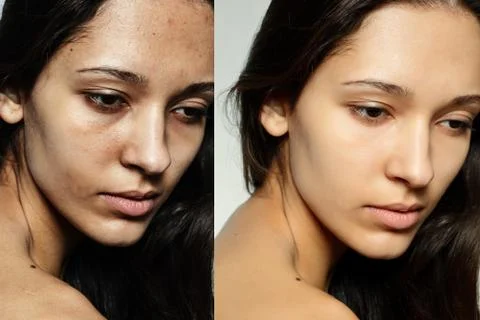 Before and after cosmetic operation. Stock Photos