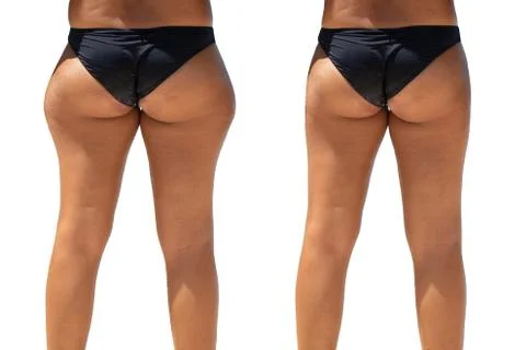 Before and after gluteoplasty surgery, a closeup and rear view on the legs an Stock Photos