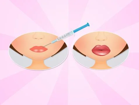 Before and after lip augmentation Stock Illustration
