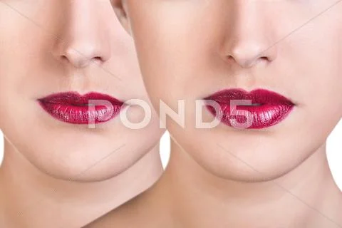 Before And After Lip Filler Injections.