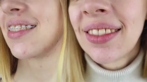 Before and after remove braces. On left is a girl in a metal bracket system, and Stock Footage 212878154