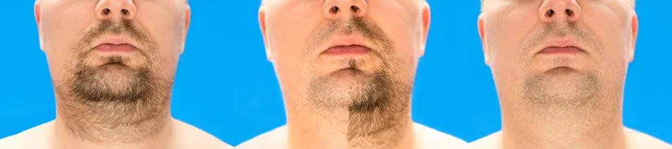Before and after shaving. collage of young man with unformed, untrimmed, over Stock Photos