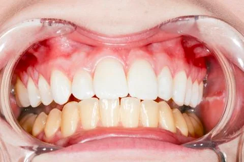 Before and after teeth bleaching or whitening treatment. Close-up of young Ca Stock Photos
