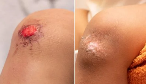 A before and after view on the grazed knee of a young child. Fresh and bleedi 스톡 사진