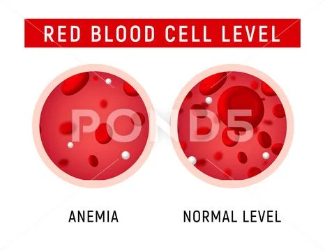 Anemia problem circulatory iron body diagram background. Anaemia ...