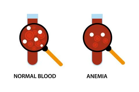 Anemia problem circulatory iron body diagram background. Stock Illustration