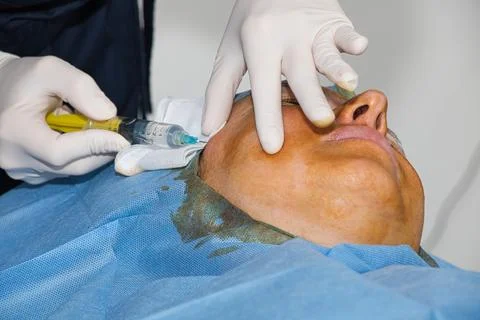 Anesthesia administered before a facelift using absorbable threads. 스톡 사진