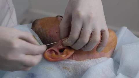 Anesthesia injection, before the correction of thread lifting of the face Stock Footage 201091782