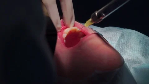 Anesthesia, Maxillofacial Surgery Stock Footage 74918126
