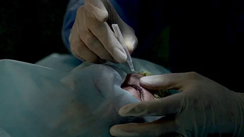 Anesthesia before surgery laser vision correction Video stock 98461890