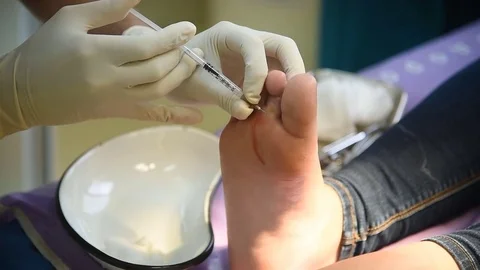 Anesthetic injection in the foot Video stock 80945625