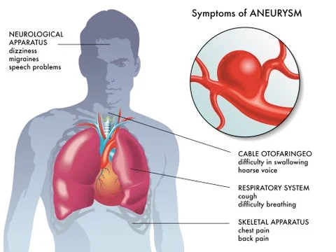 Aneurysm symptoms Stockillustratie