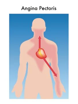 Angina Pectoris Stock Illustration