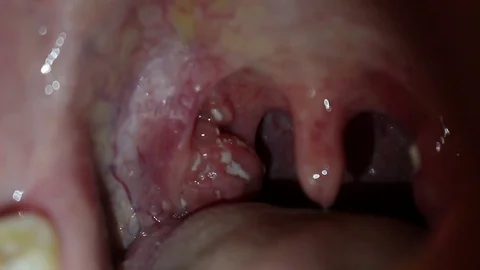 Angina, purulent tonsillitis, throat with pus on tonsils Stock Footage